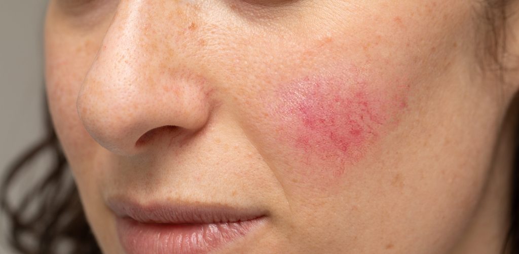 Woman with blotchiness on the cheek caused by bacterial infection