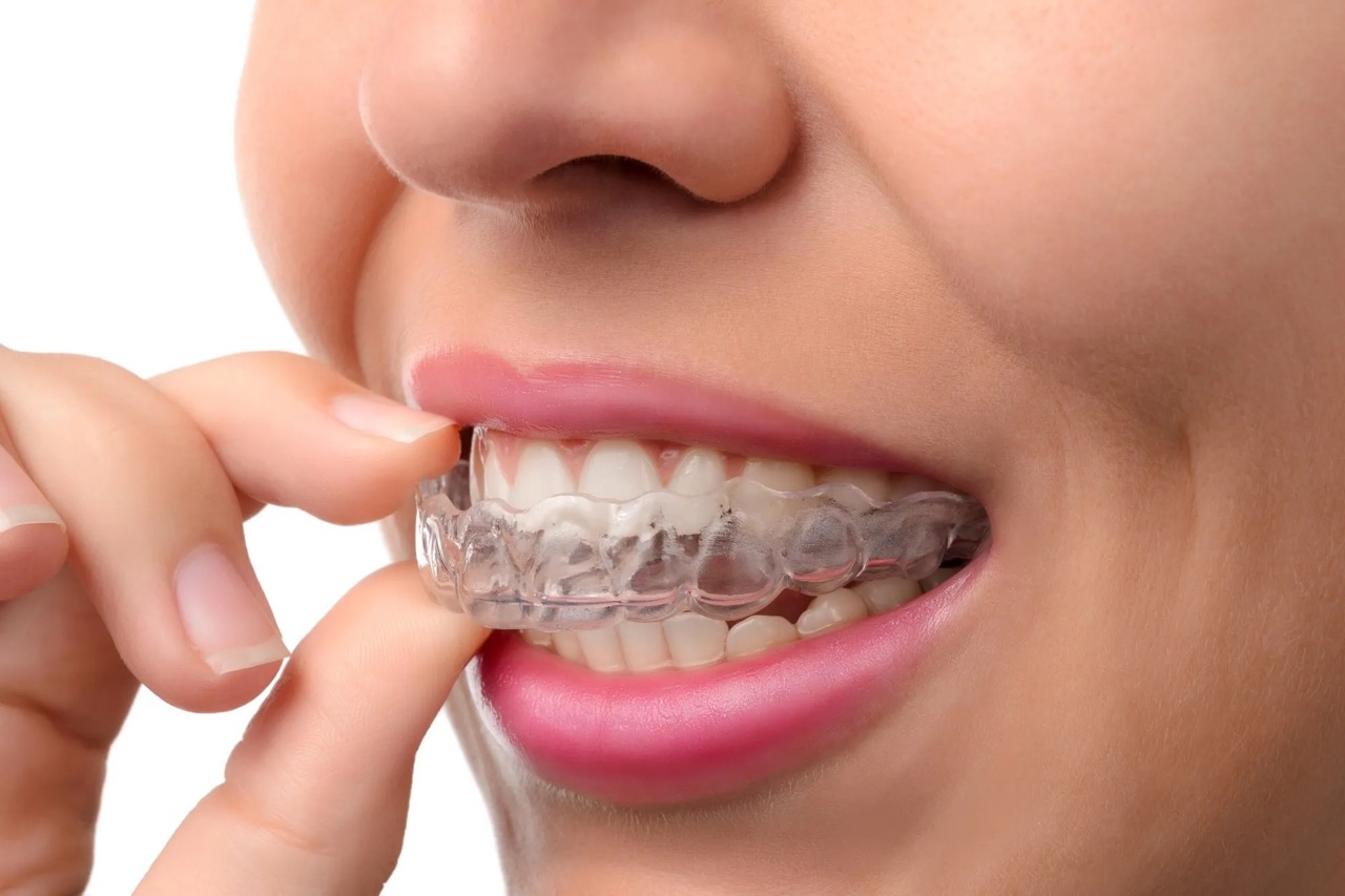How To Store Invisalign Retainers