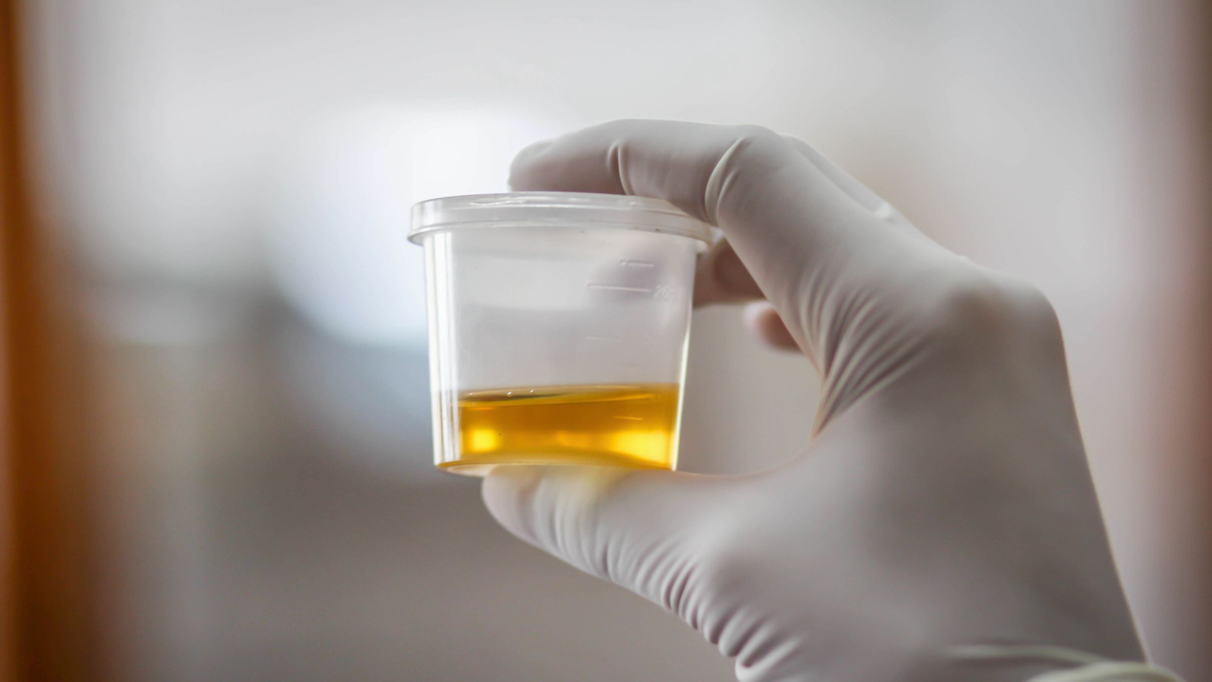 How To Store Urine Sample