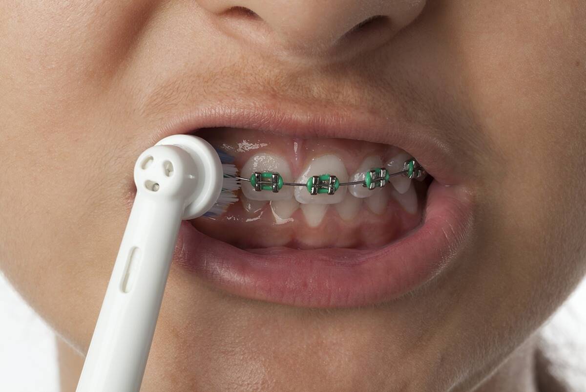 How To Brush Teeth With Braces Using An Electric Toothbrush