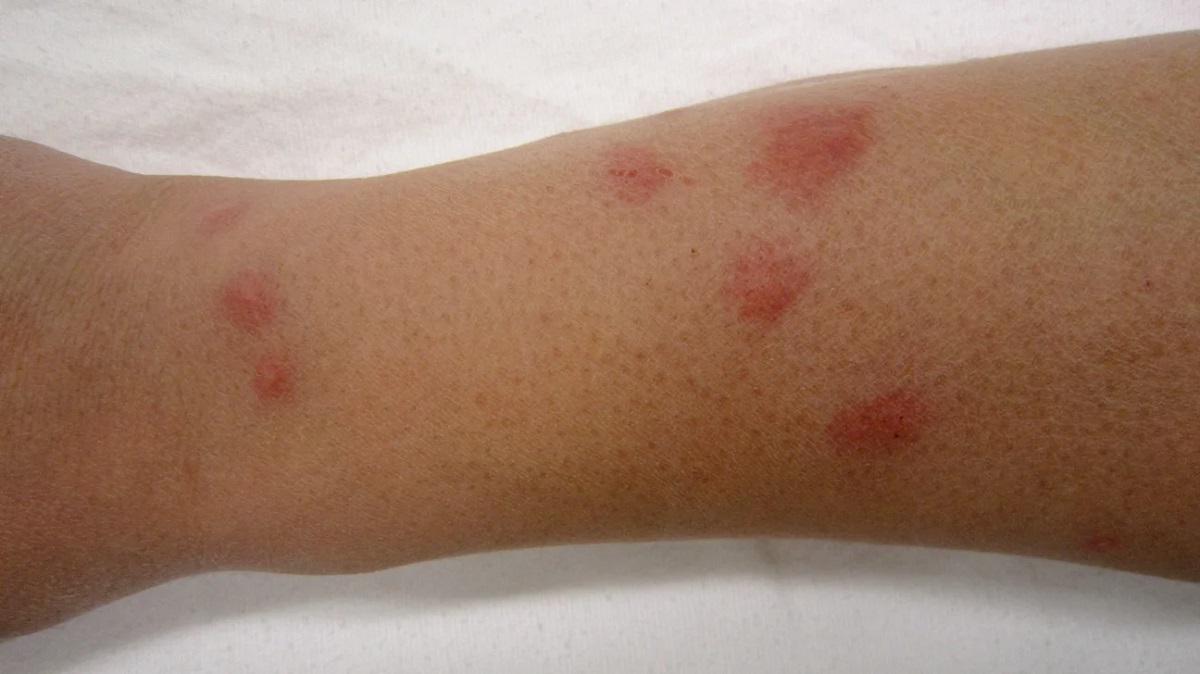 What Bed Bug Bites Look Like