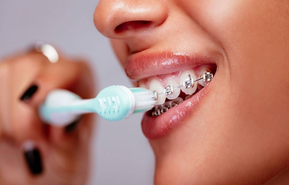 Which Electric Toothbrush Is Best For Braces
