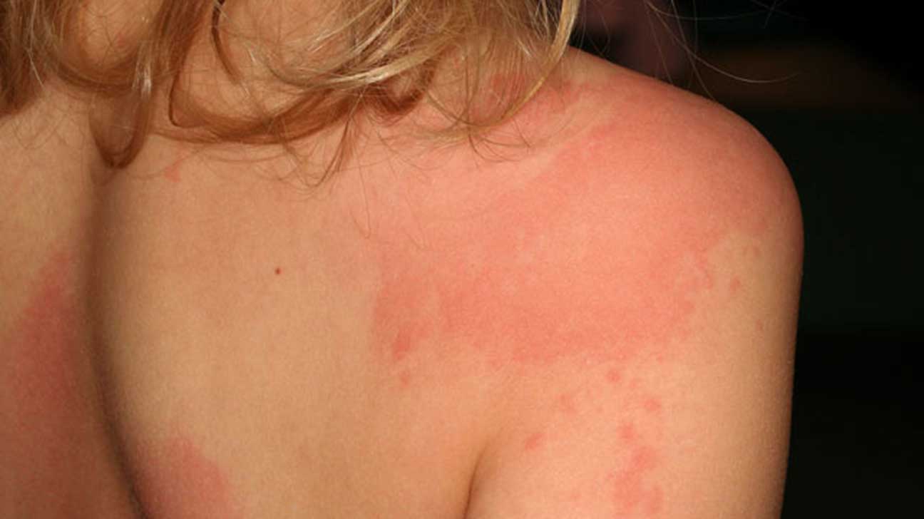 How To Treat Grass Burn On Skin