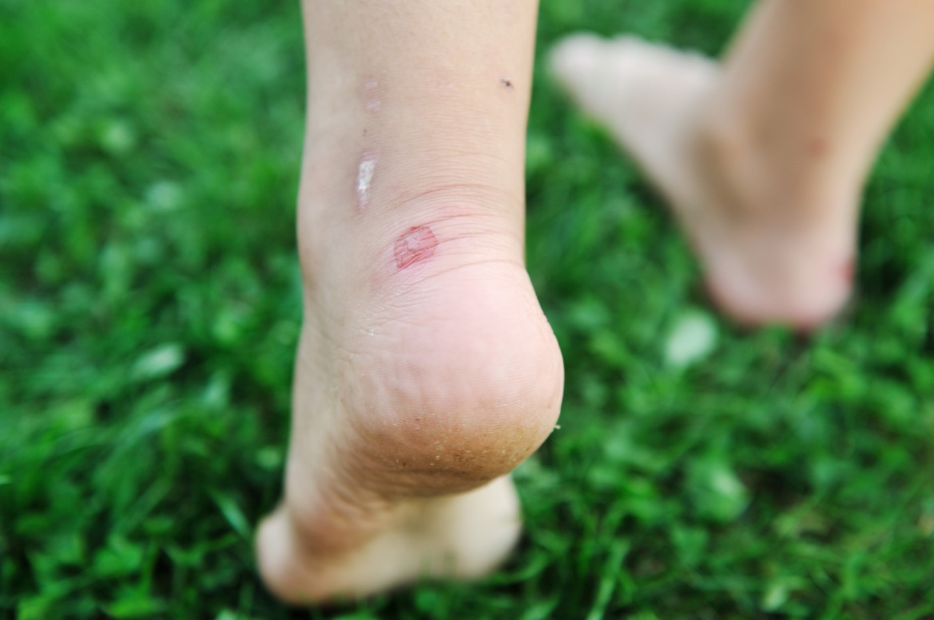 Why Grass Makes You Itch